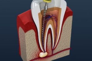 Cross-section of a tooth getting a root canal